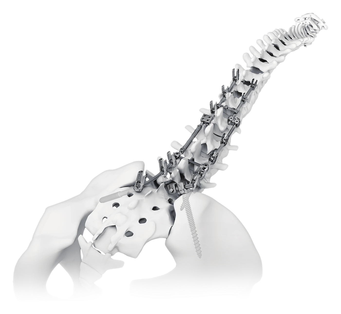 HOBBIT posterior fixation construct on a spine model