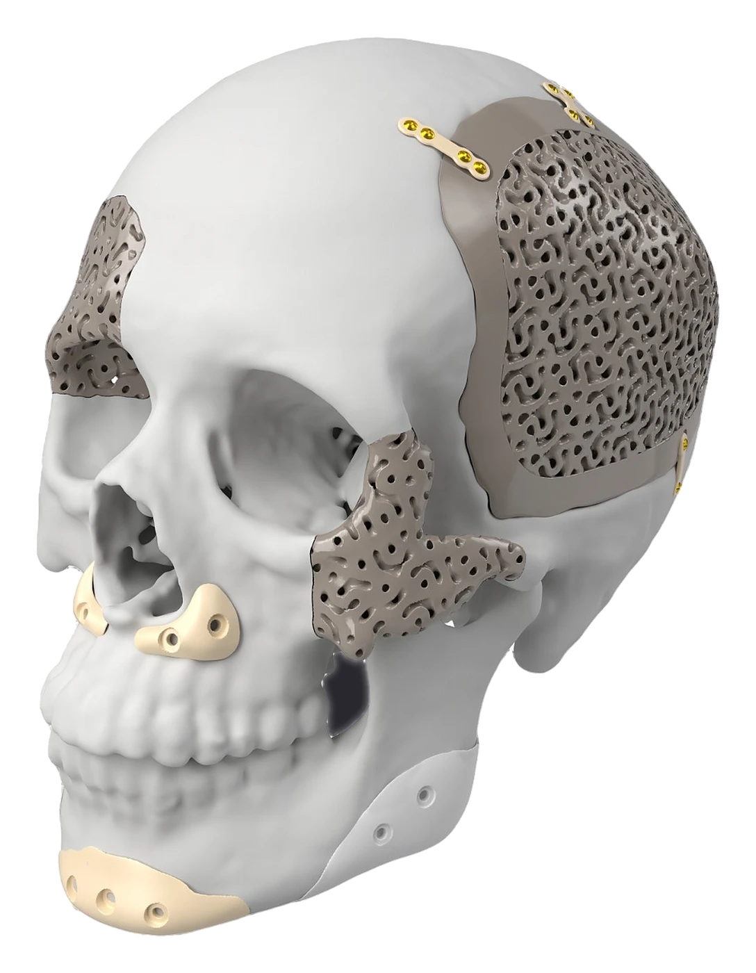 PEEK + BCP patient-specific implants on a skull model