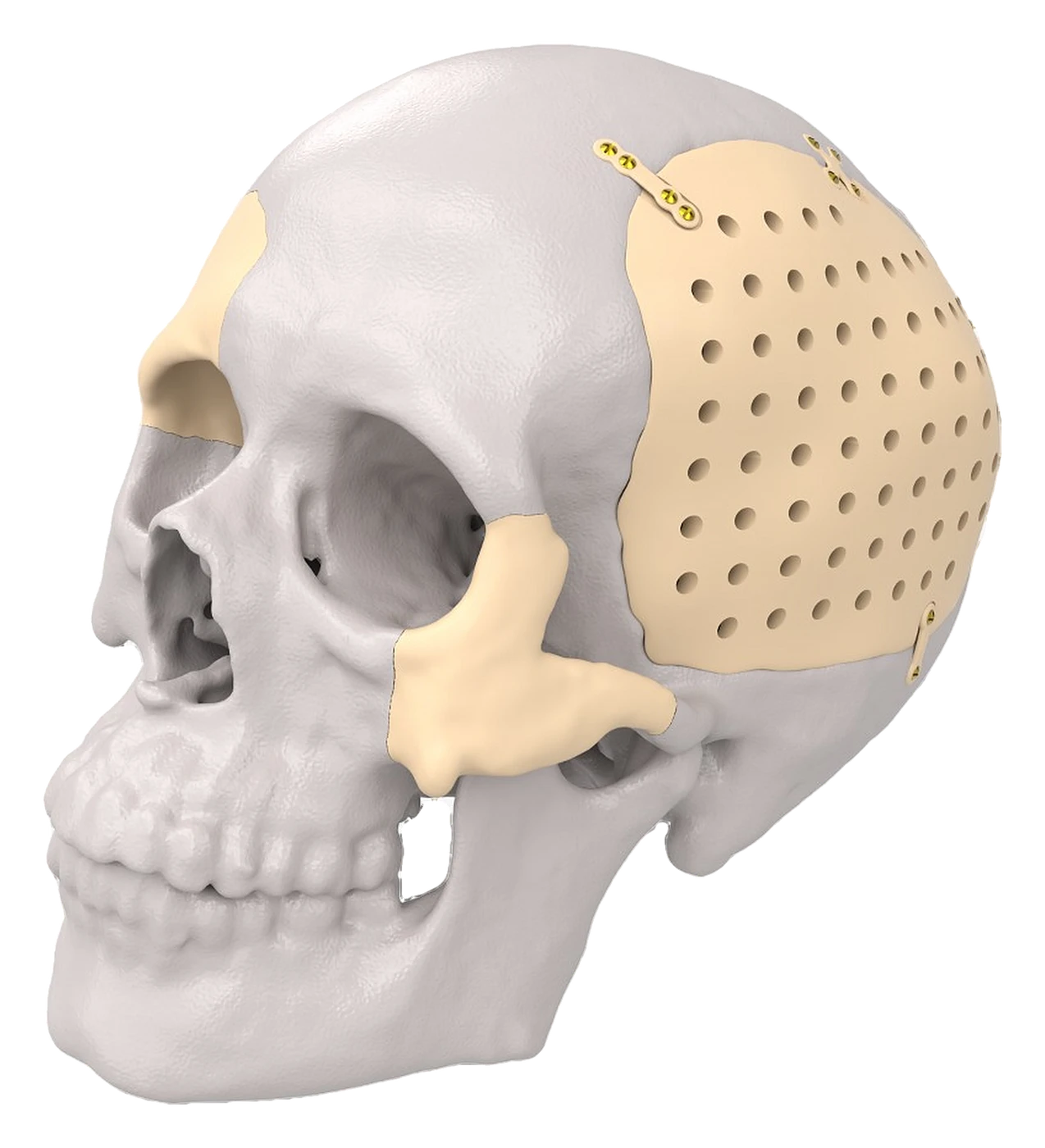 Customised PEEK cranial and facial implants fitted to a skull model