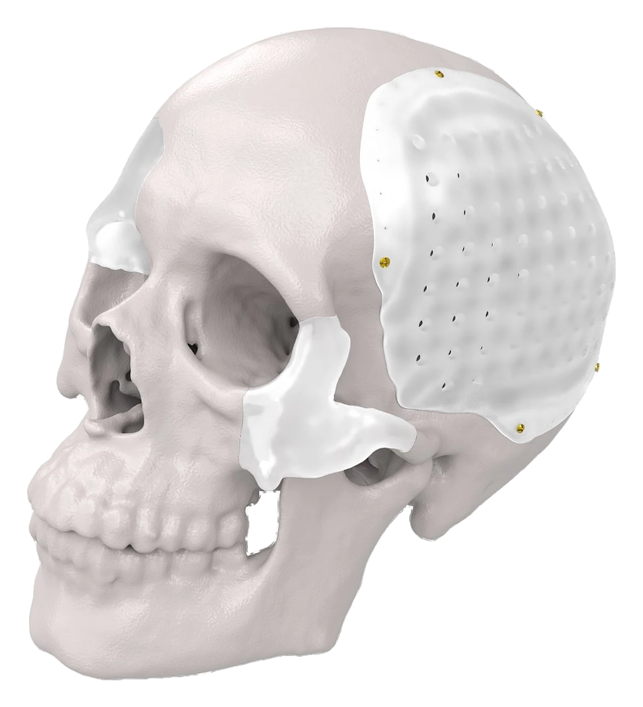UHMWPE patient-specific cranial implant on a skull model